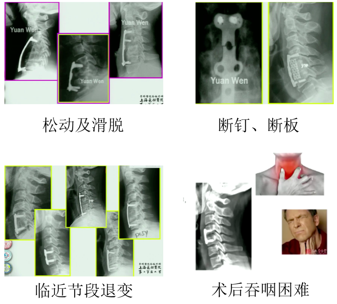 颈椎前路融合器